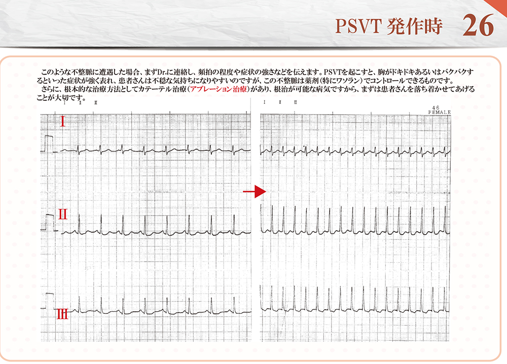 26．PSVT発作時 | ハート先生の心電図教室